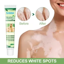 Sumifun Vitiligo Cream