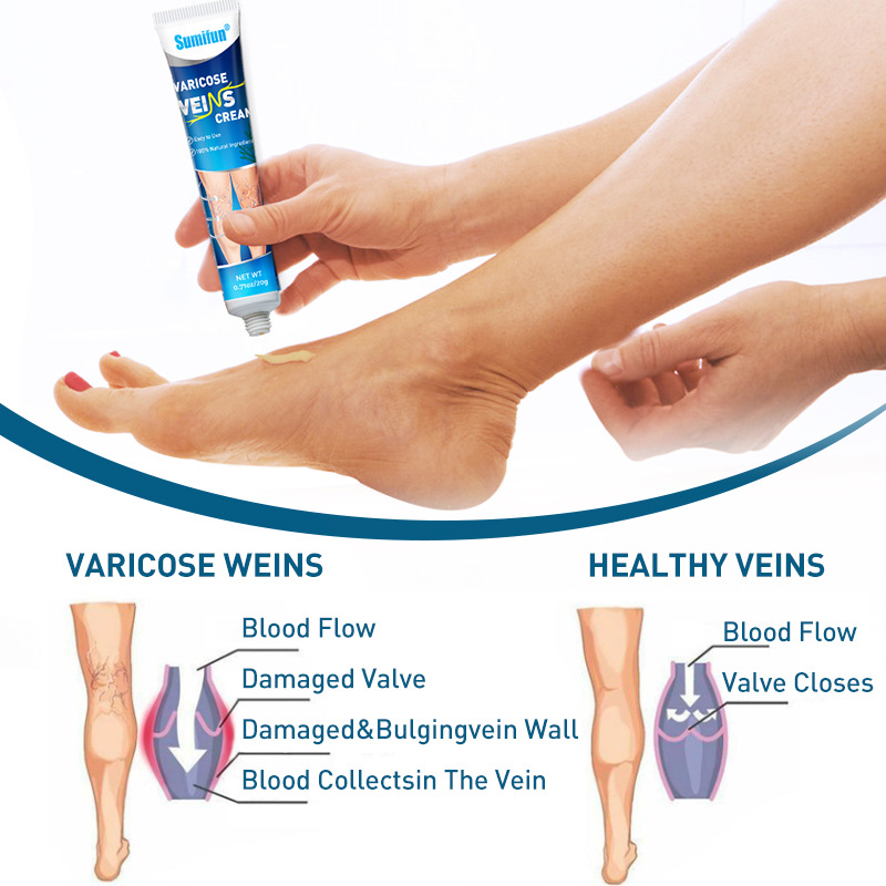 Sumifun Varicose Veins Cream Introduced-2